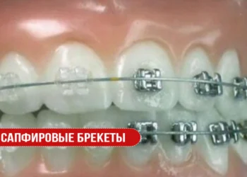 Сапфировые брекеты