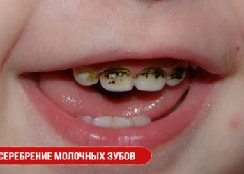 Серебрение молочных зубов