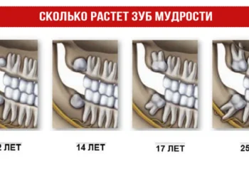 Сколько растет зуб мудрости