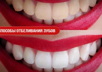 Способы отбеливания зубов