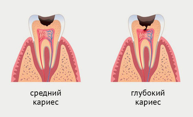 Средний и глубокий кариес 