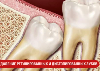Удаление ретинированных и дистопированных зубов