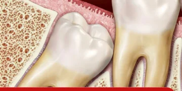 Удаление ретинированных и дистопированных зубов