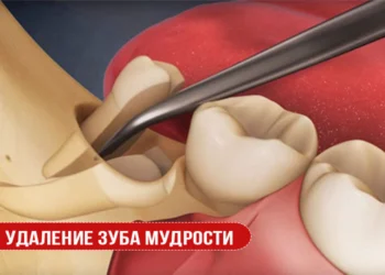 Удаление зуба мудрости