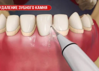 Удаление зубного камня