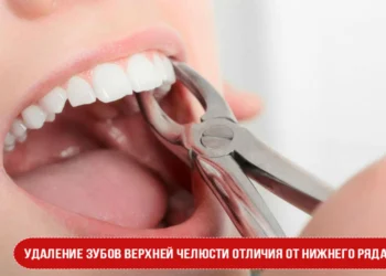 Удаление зубов верхней челюсти отличия от нижнего ряда?