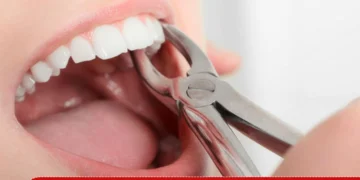 Удаление зубов верхней челюсти отличия от нижнего ряда?
