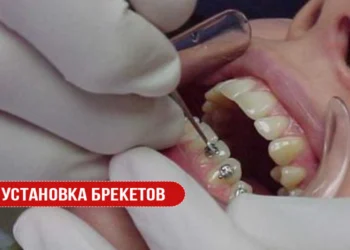 Установка брекетов