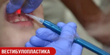 Вестибулопластика