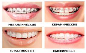 Виды брекет-систем