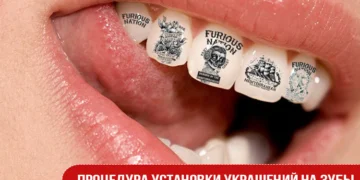 Виды украшений зубов: скайсы, твинклс, наклейки, татуировки