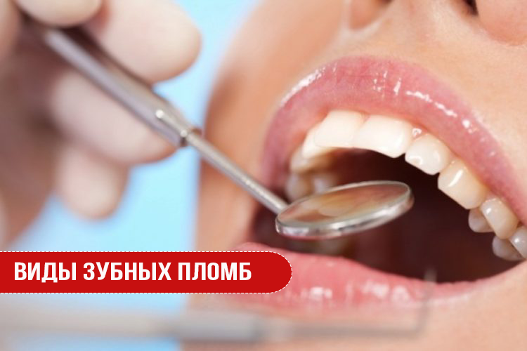 Виды зубных пломб