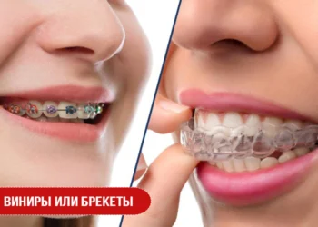 Виниры или брекеты