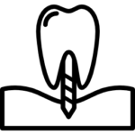 Імплантація зуба
